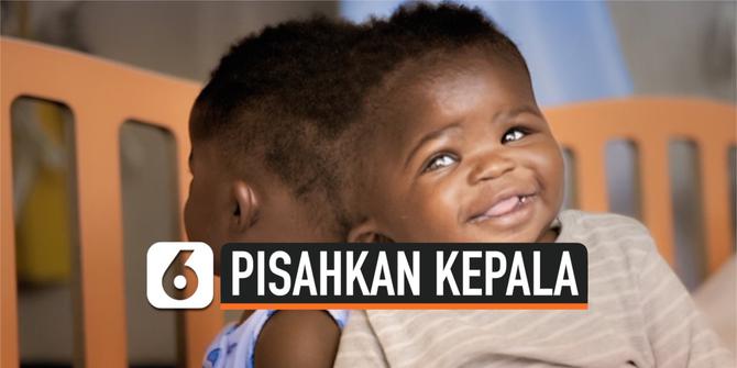 VIDEO: Ajaib! Dokter Berhasil Pisahkan 2 Tengkorak Bayi yang Menempel