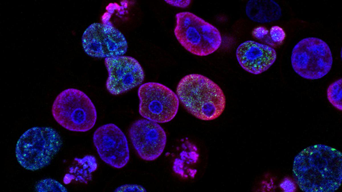 Kanker Tak Pilih Usia, Remaja dan Dewasa Muda Bisa Kena