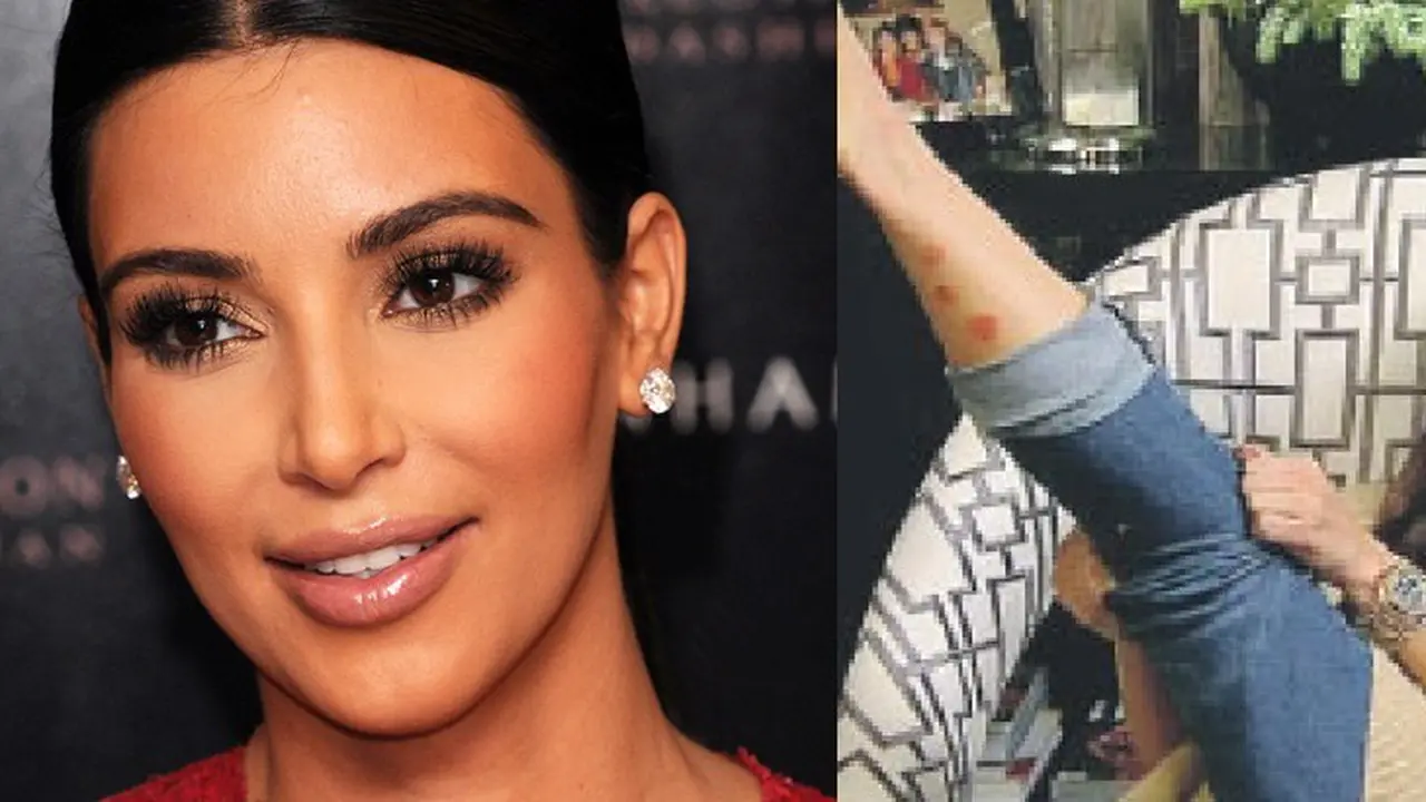 Kim Kardashian terkena psoriasis