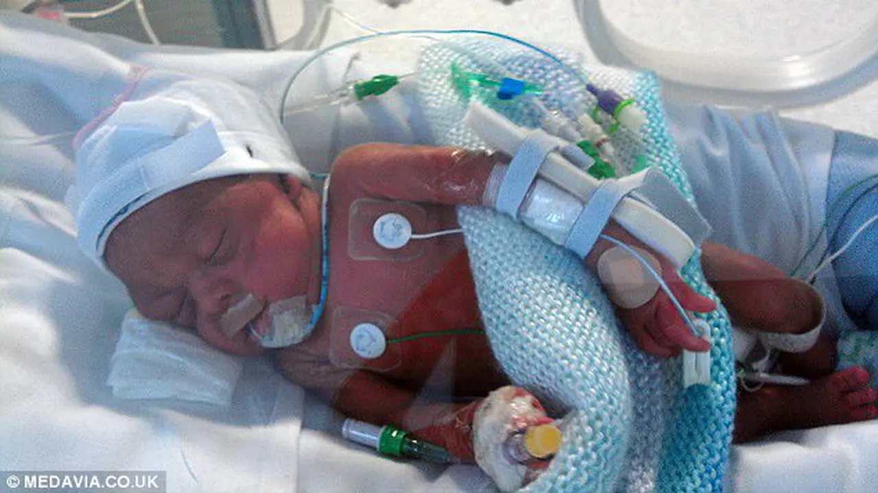 Dokter Salah Masukan Tabung, Satu Dari Bayi Kembar Ini Meninggal