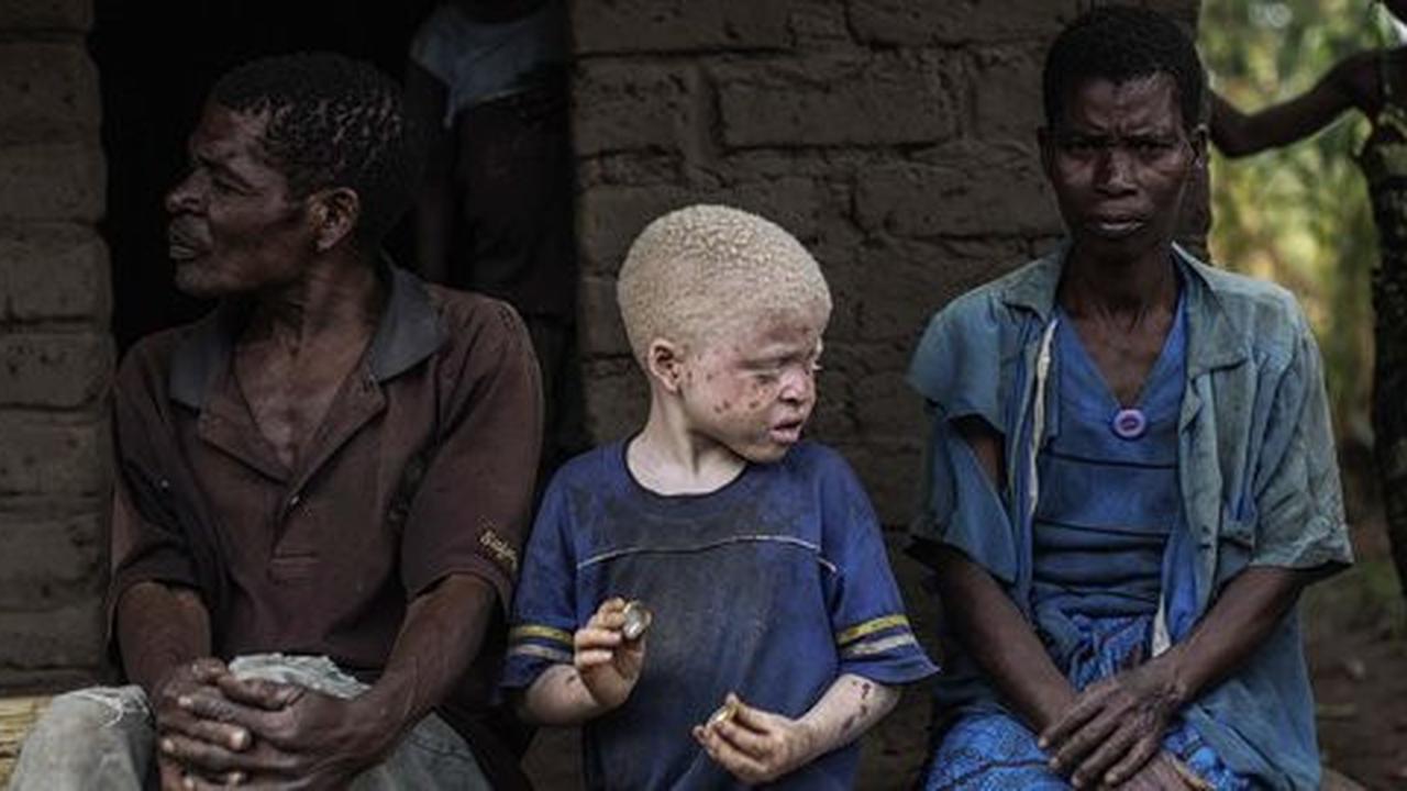 Dianggap titisan roh jahat, orang albino diburu di Tanzania