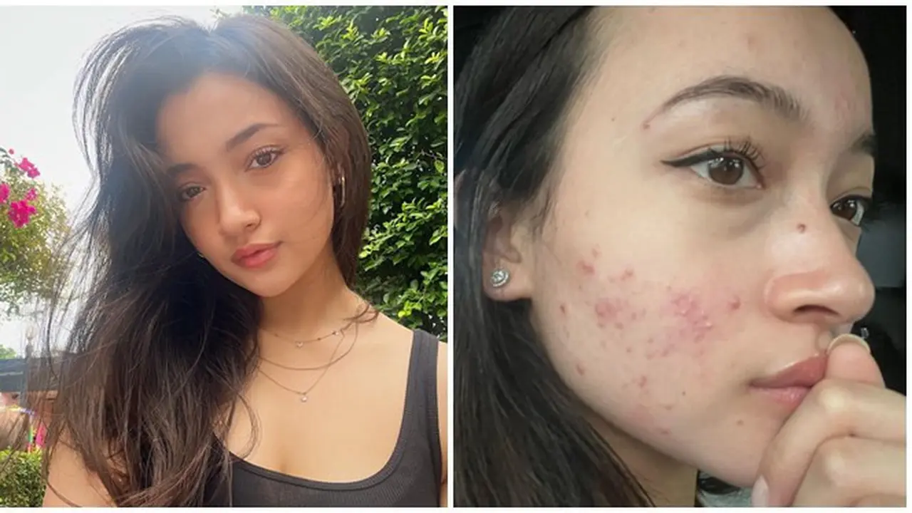 7 Potret Megan Domani Pamer Wajah Berjerawat, Sempat Takut Bertemu Orang Lain