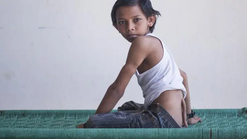 Punya Ekor, Bocah di India Dianggap Titisan Dewa