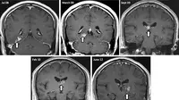 Dokter melakukan scan otak, mereka terkejut karena melihat ada sesuatu yang bergerak-gerak di otak pria itu.