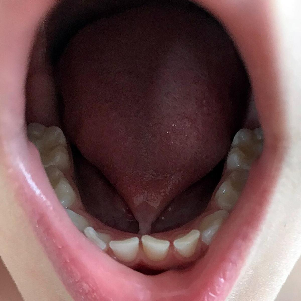 Ilustrasi Tongue Tie