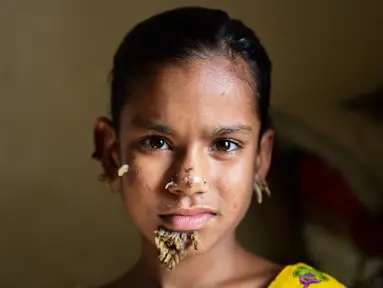Sahana Khatun ditemui saat menjalani perawatan di sebuah rumah sakit di Dhaka, Bangladesh, 30 Januari 2017. Gadis 10 tahun tersebut tengah dirawat karena mengalami kondisi langka yang dikenal sebagai sindrom "manusia pohon". (STR/AFP)