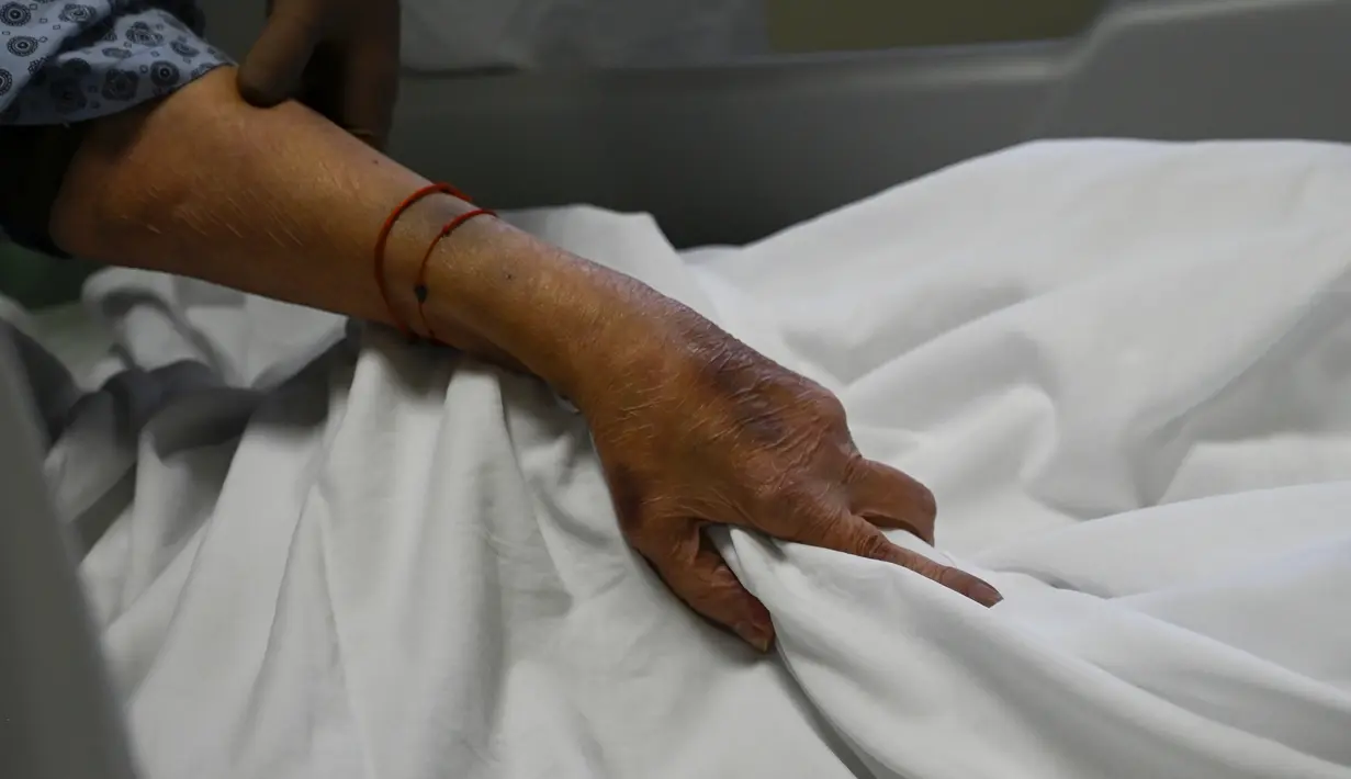 Pasien Covid-19 menggenggam selimut saat mencoba batuk di ICU Rumah Sakit Lozenets di Sofia, Selasa (9/11/2021). Pemerintah Bulgaria melaporkan 334 kematian harian akibat COVID-19 pada Selasa, yang merupakan rekor tertinggi sejak awal pandemi. (Nikolay DOYCHINOV/AFP)