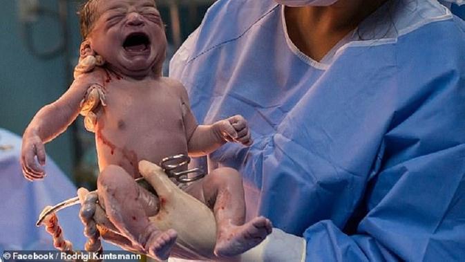 Seorang bayi asal Brasil tampilkan wajah cemberut saat lahir ke dunia. Facebook/ Rodrigo Kunstmann