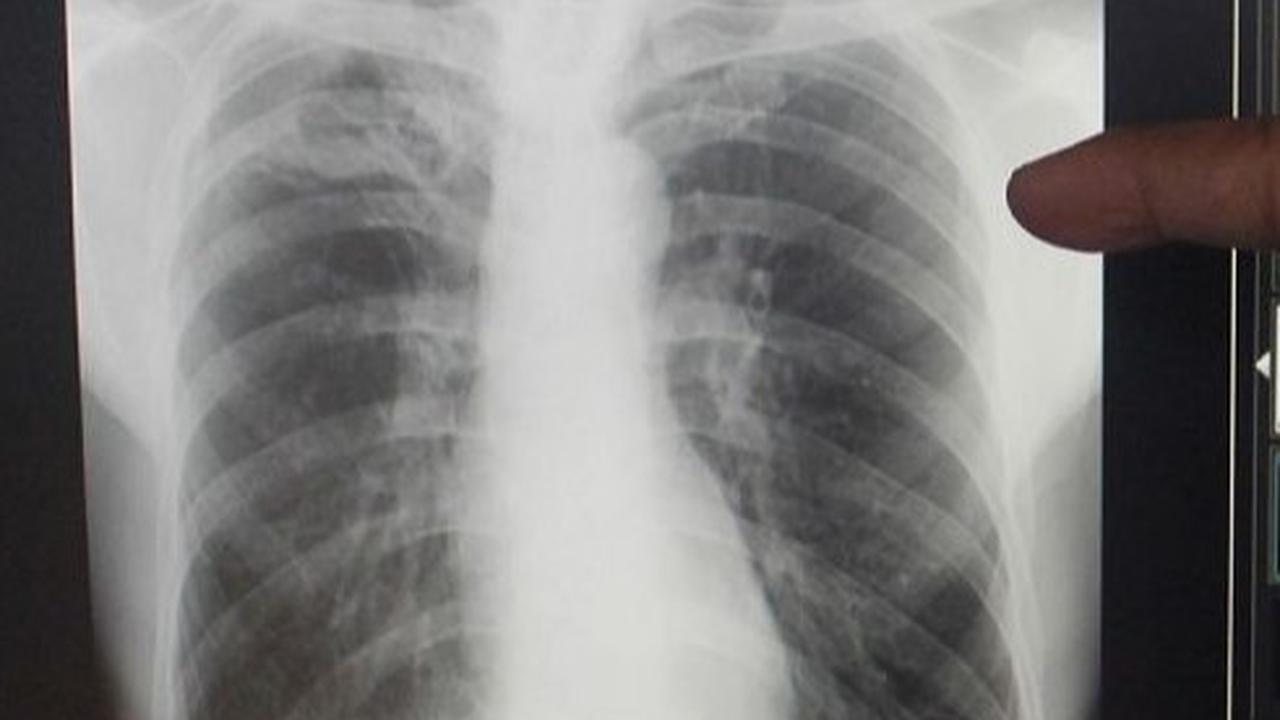 Indonesia Rekrut 2.095 Partisipan Uji Klinik Vaksin TBC M72: Harapan Baru Pemberantasan Tuberkulosis
