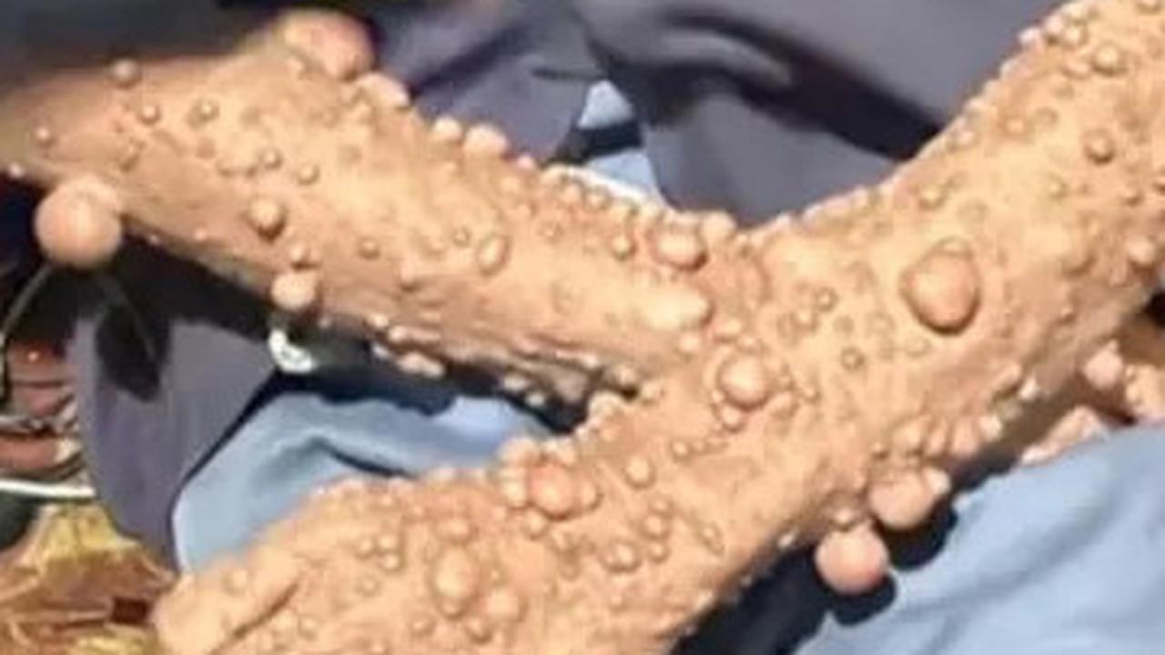 Kisah Pilu Pria Sukabumi dengan Kutil Seluruh Tubuh, Puluhan Tahun Tak Dapat Pengobatan