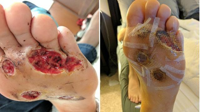 Bakteri pemakan daging