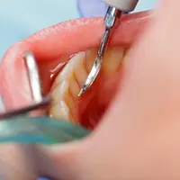 Karang dan plak gigi yang harus selalu dibersihkan. (Image: res.cloudinary.com)