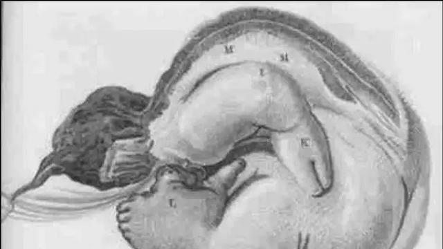 Pria Punya Kembaran di Dalam Perut