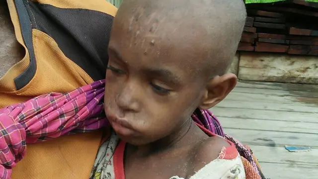 asmat, campak