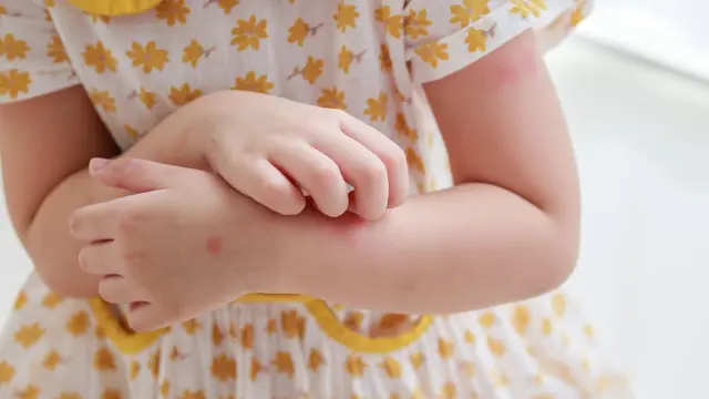 Ilustrasi  Probiotik dapat Mencegah Eksim Pada Anak-anak. credit: Shutterstock