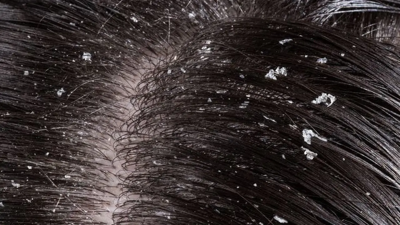Rambut dengan Ketombe