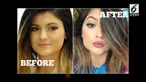 Perubahan wajah Kylie Jenner ramai dibicarakan warga net. Ternyata ada 6 operasi yang Kylie lakukan pada wajahnya. 