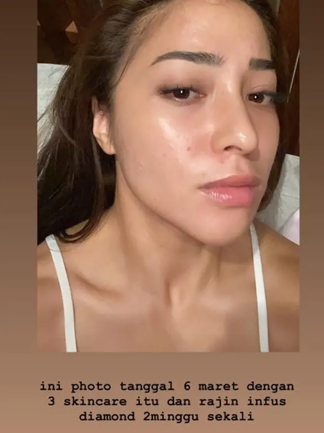 Unggah Foto Berjerawat, Ini 6 Potret Nikita Willy Tampil Natural