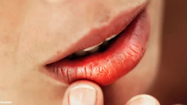 bibir-kering130711b.jpg