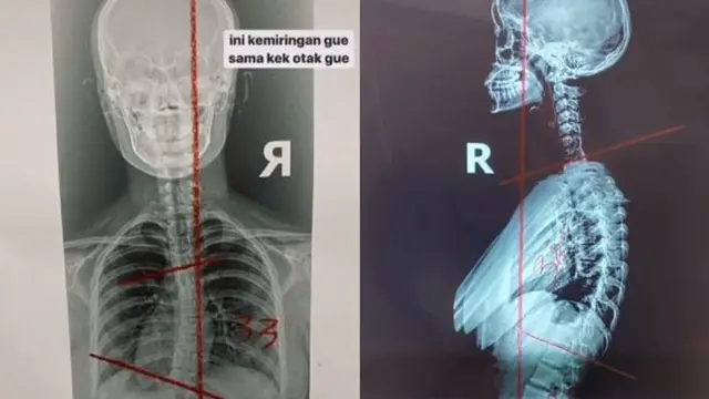 Sempat Insecure, Ini 6 Potret Perjuangan Cinta Kuya Hadapi Sakit Skoliosis
