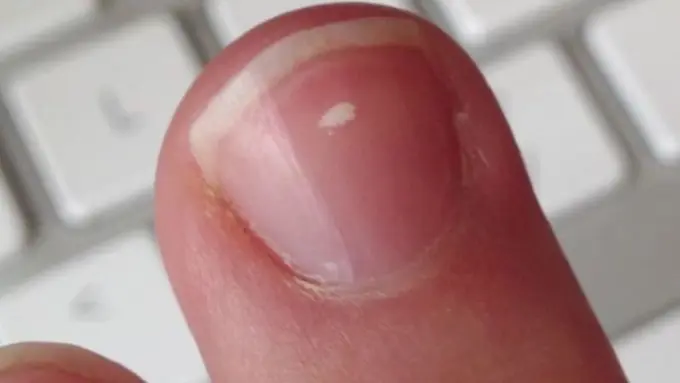 Hati-hati, Kuku Tumbuh ke Dalam Bisa Sebabkan Kaki Diamputasi