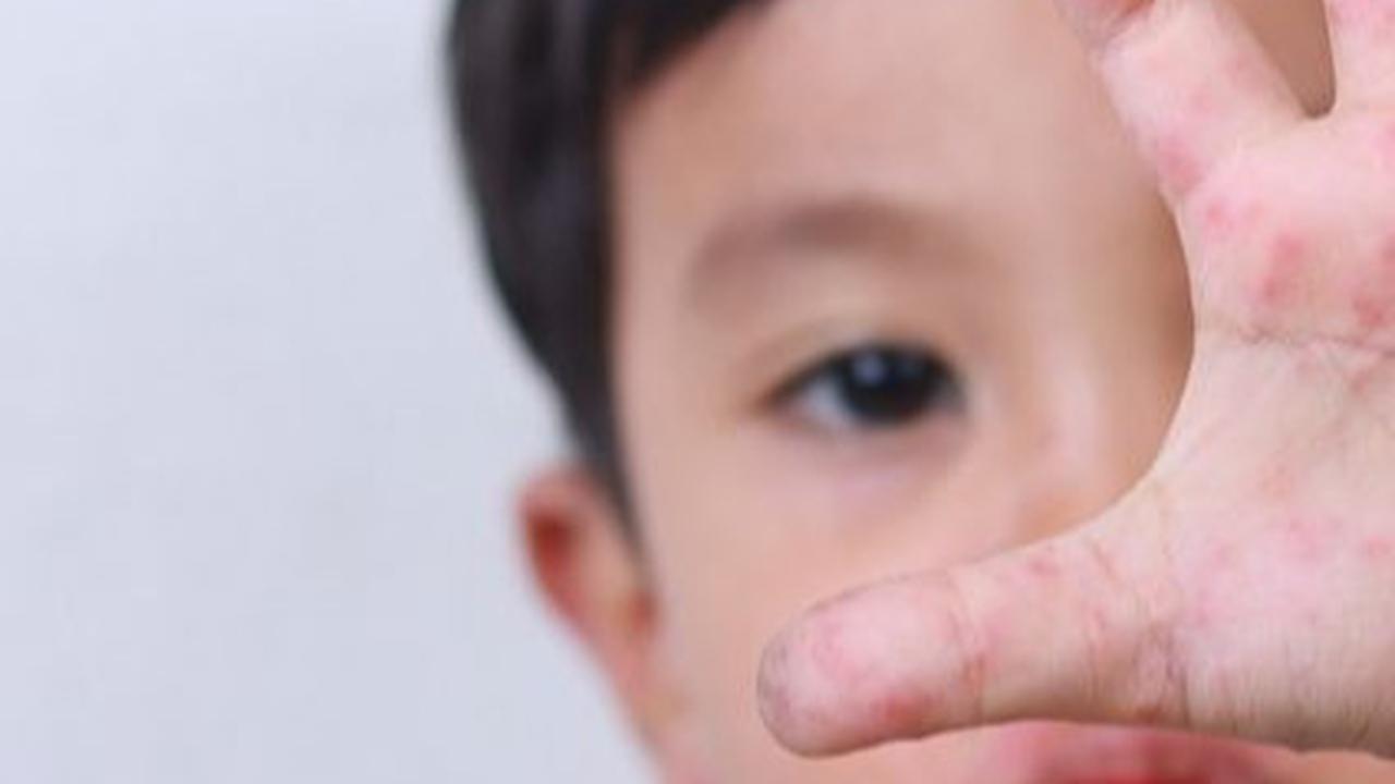 Waspada Penularan Flu Singapura Pada Anak Cenderung Meluas Saat Mudik