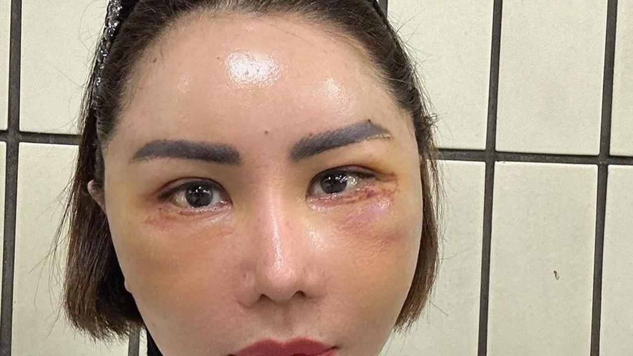 Potret Femmy Permatasari Setelah Oplas di Korea, Rela Wajah Bengkak dan 'Jelek' Dulu Pasca Lakukan 6 Prosedur Operasi