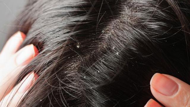 Kurangi Ketombe Menggunakan Garam