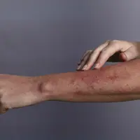 Meskipun gejala masing-masing penderita lupus itu berbeda, namun inilah gejala yang umum terjadi akibat penyakit lupus. (Foto: Verywell)