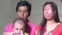 Seorang pria setia mendampingi istrinya yang memiliki wajah rusak akibat disiram air keras saat bekerja (Sumber foto: Formaxmanroe.com)