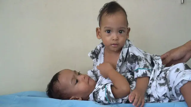 Bayi kembar siam
