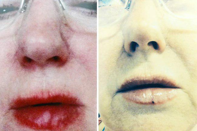 Reaksi alergi yang terjadi pada bibir Lynda setelah memakai lipgloss | foto: copyright dailymail.co.uk