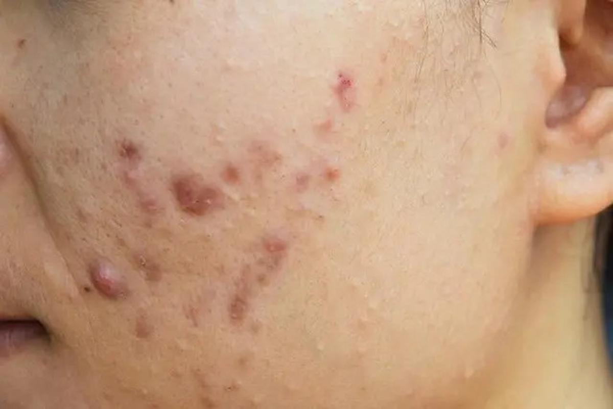 6 Gejala Kolesterol Tinggi yang Muncul dan Terlihat pada Kulit, Perhatikan Tandanya