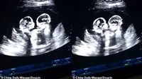 Video USG tunjukkan bayi kembar sedang berantem. (Sumber: China Daily)