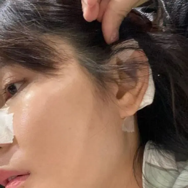 Angela Lee menyesal dan kapok telah menjalani operasi hidung