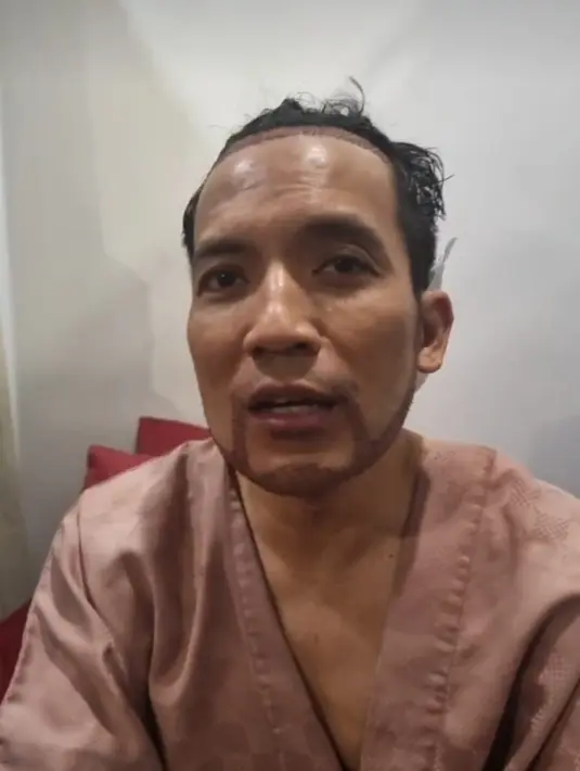 Desta memutuskan untuk transplantasi rambut lantaran kurang percaya diri dengan keningnya yang lebar. Transplantasi menggunakan rambutnya sendiri di belakang kepala. (Foto: Instagram/ dr_tompi)