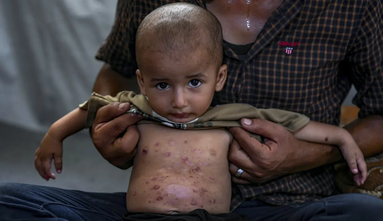 Penyebabnya adalah kondisi mengerikan di kamp-kamp tenda yang penuh sesak yang menampung ratusan ribu warga Palestina yang terusir dari rumah mereka.  (AP Photo/Abdel Kareem Hana )