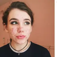 Emma berjuang atasi jerawat. (Foto: Instagram/emmamyhoney)