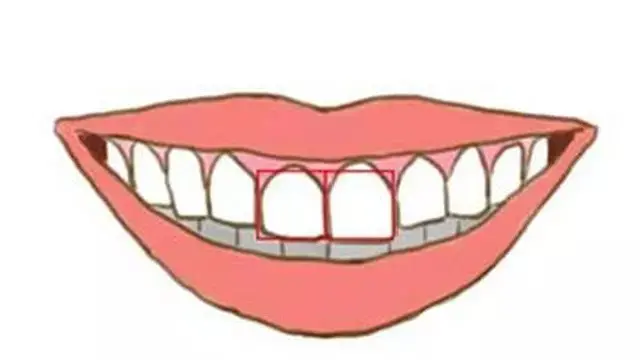 Ilustrasi gigi depan