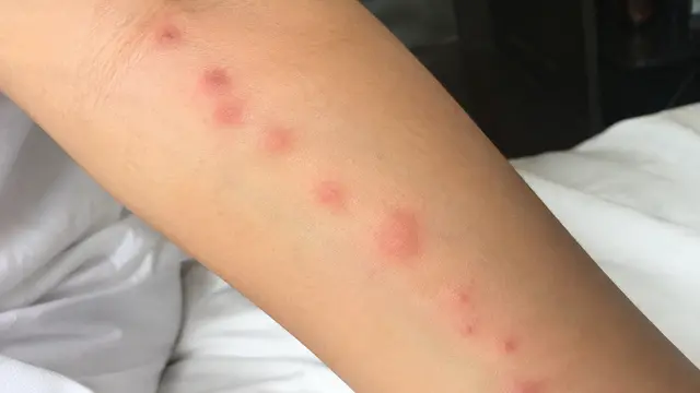 Bekas Gigitan Kutu Kasur (AI Generated)