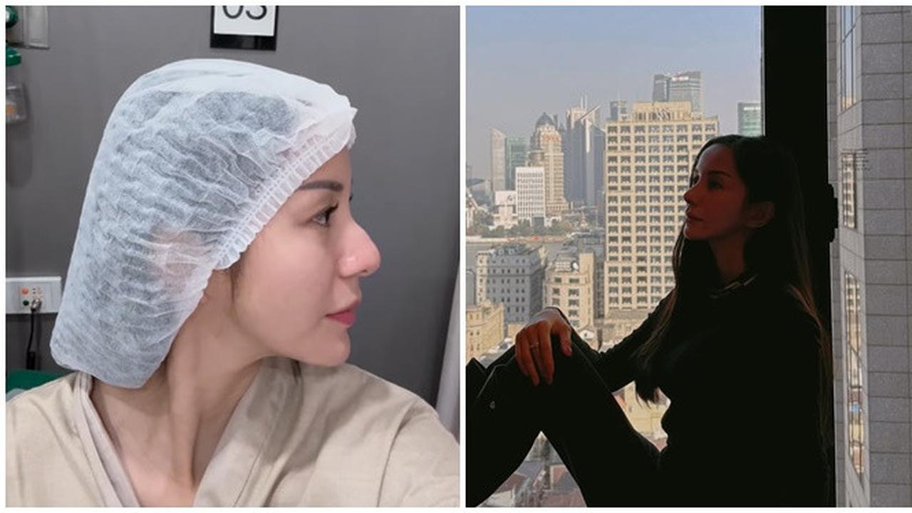 6 Potret Terbaru Kirana Larasati Usai Rhinoplasty, Akui untuk Estetika