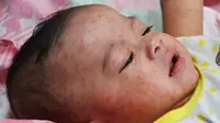 Penyakit Tampek pada Bayi (Sumber: Wikimedia Commons)