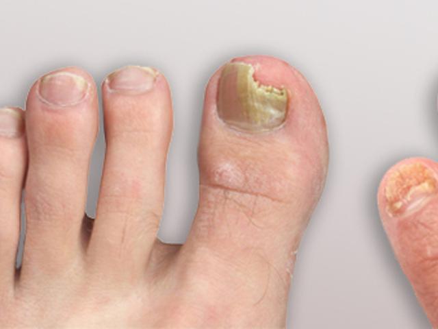 Bahan Alami Ini Mampu Atasi Noda Kunyit Di Tangan Dan Kuku Semua Halaman Nakita