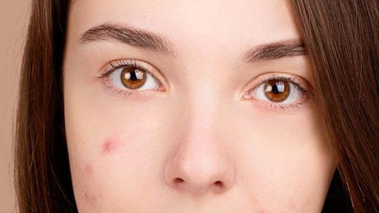 Cara Menghilangkan Bekas Jerawat secara Alami, 15 Bahan Ini Ampuh Hilangkan Jerawat dalam Semalam