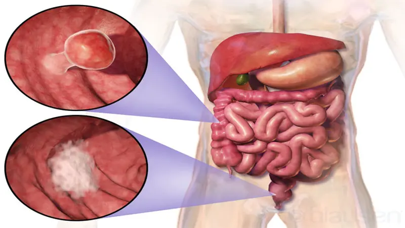 Kanker Usus Besar