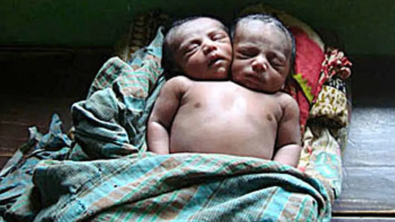 Saling Berbagi Tubuh, Bayi Ini Terlahir dengan Dua Kepala