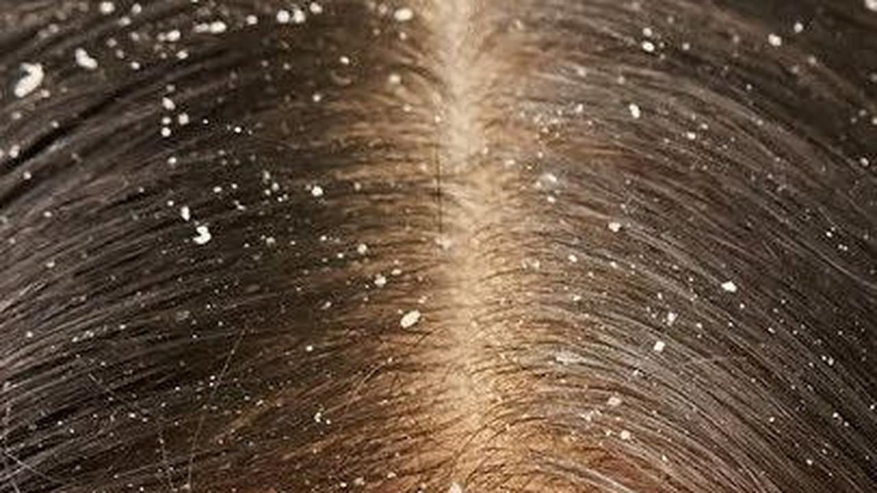 Apakah Ketombe Menular?<br>