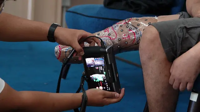 Kaki dan Tangan Prostesis Jadi Lebih Fungsional dengan Sentuhan Teknologi 3D Scan dan Printer. Foto: EQUIBILITY.