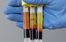 Waspadai Tanda-Tanda Asam Urat yang Dapat Terlihat di Urine Anda
