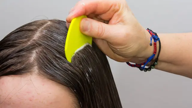 Ampuh Banget, Ini Cara Mudah Menghilangkan Kutu Rambut Beserta Telurnya